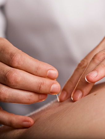 Accupuncture